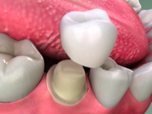 dental-crown-porcelain-colombia